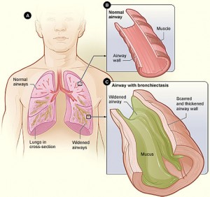 Bronchial Dilatation in Asthma